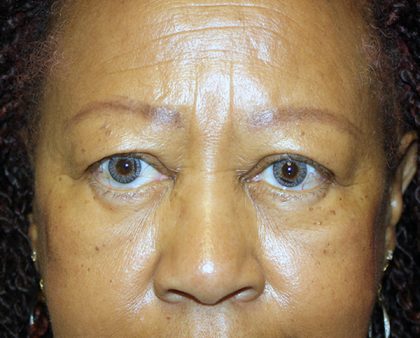 Blepharoplasty Before & After Patient #764