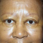 Blepharoplasty Before & After Patient #764