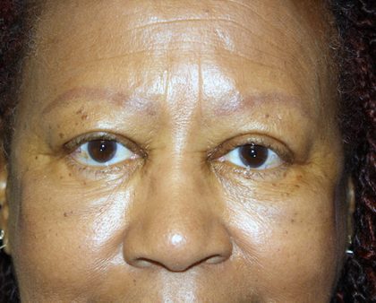 Blepharoplasty Before & After Patient #764