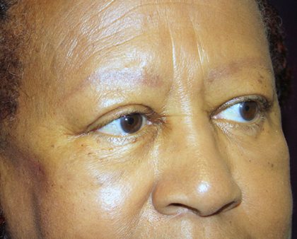 Blepharoplasty Before & After Patient #764