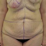 Tummy Tuck Before & After Patient #712
