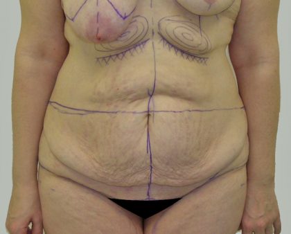 Tummy Tuck Before & After Patient #712