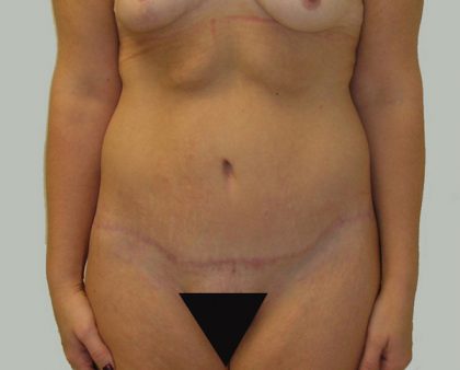 Tummy Tuck Before & After Patient #712