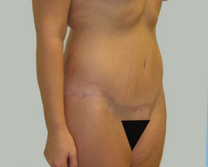 Tummy Tuck Before & After Patient #712