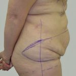 Tummy Tuck Before & After Patient #712
