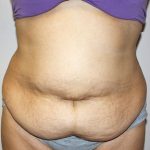 Tummy Tuck Before & After Patient #528