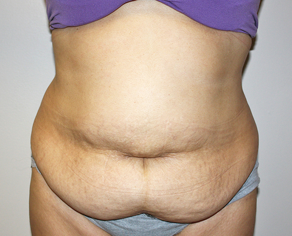 Tummy Tuck Before & After Patient #528