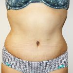 Tummy Tuck Before & After Patient #528