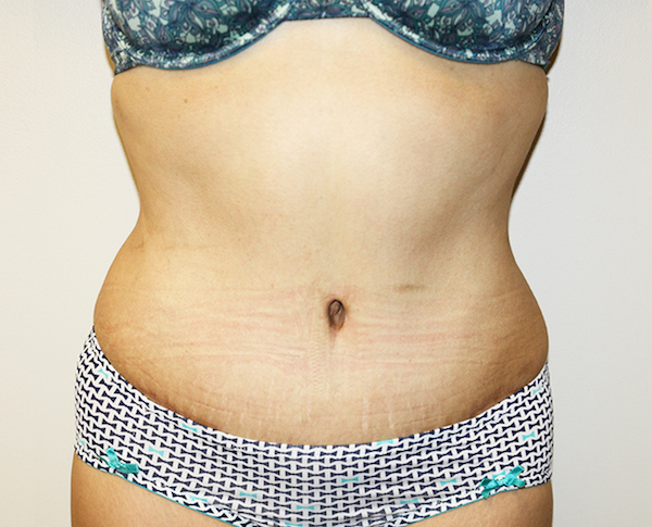 Tummy Tuck Before & After Patient #528