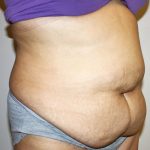 Tummy Tuck Before & After Patient #528