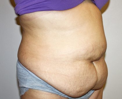 Tummy Tuck Before & After Patient #528