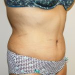 Tummy Tuck Before & After Patient #528