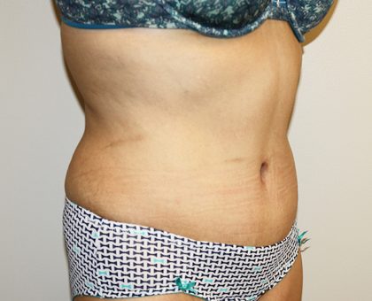 Tummy Tuck Before & After Patient #528