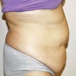 Tummy Tuck Before & After Patient #528