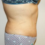 Tummy Tuck Before & After Patient #528