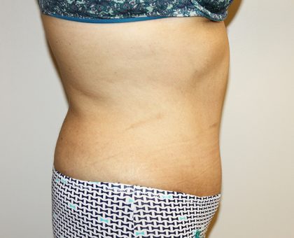 Tummy Tuck Before & After Patient #528