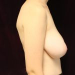 Breast Reduction Before & After Patient #912