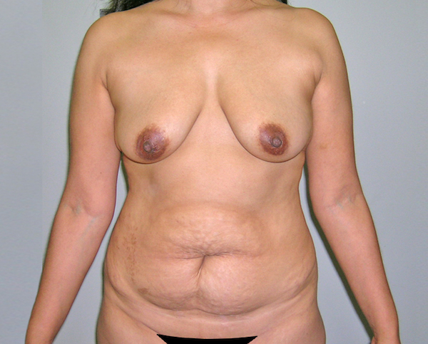 Mommy Makeover Before & After Patient #1289