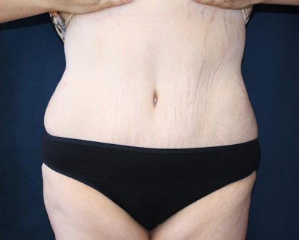 Major Weight Loss Tummy Tuck Before & After Patient #1240