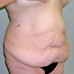 Major Weight Loss Tummy Tuck Before & After Patient #1240