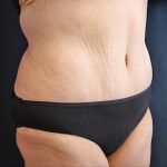Major Weight Loss Tummy Tuck Before & After Patient #1240