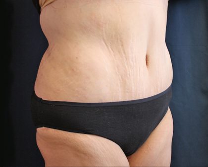 Major Weight Loss Tummy Tuck Before & After Patient #1240