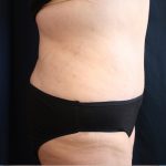 Major Weight Loss Tummy Tuck Before & After Patient #1240