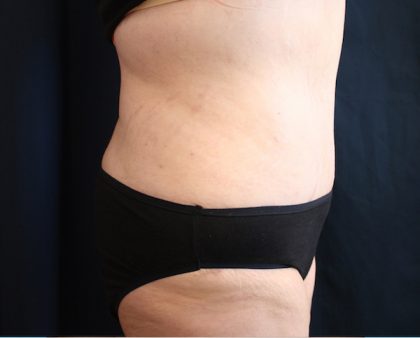 Major Weight Loss Tummy Tuck Before & After Patient #1240