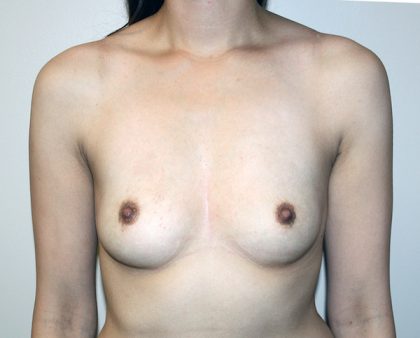 Breast Augmentation Before & After Patient #1530