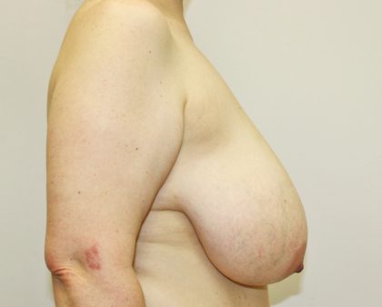 Breast Reduction Before & After Patient #982