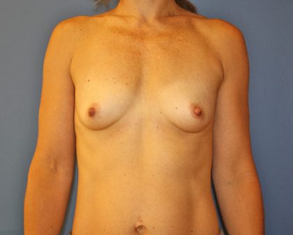 Breast Augmentation Before & After Patient #1628
