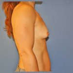 Breast Augmentation Before & After Patient #1628