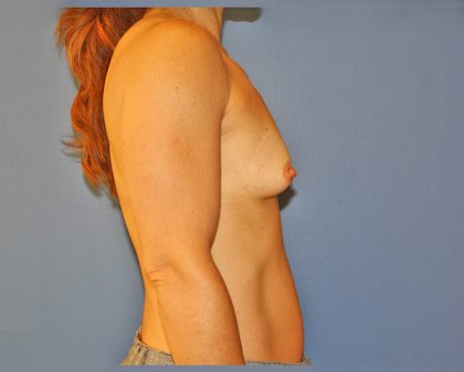 Breast Augmentation Before & After Patient #1628