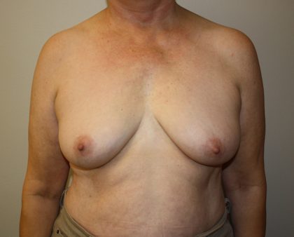 Breast Augmentation Before & After Patient #1667
