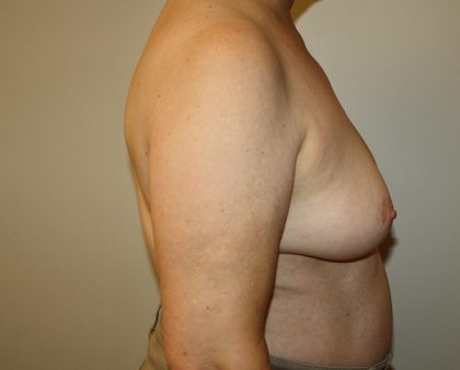 Breast Augmentation Before & After Patient #1667
