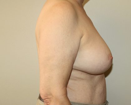 Breast Augmentation Before & After Patient #1667