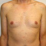 Gynecomastia Before & After Patient #1254