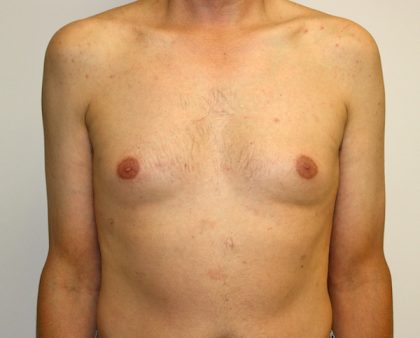 Gynecomastia Before & After Patient #1254