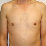 Gynecomastia Before & After Patient #1254