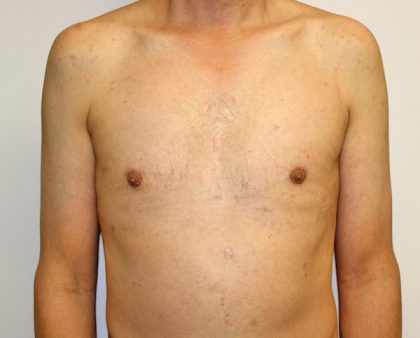 Gynecomastia Before & After Patient #1254