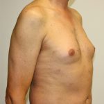 Gynecomastia Before & After Patient #1254