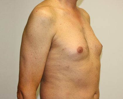 Gynecomastia Before & After Patient #1254