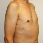 Gynecomastia Before & After Patient #1254