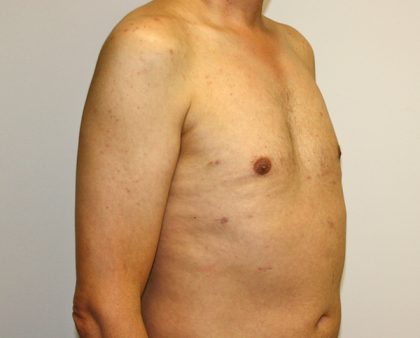 Gynecomastia Before & After Patient #1254