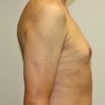 Gynecomastia Before & After Patient #1254