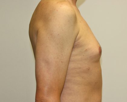 Gynecomastia Before & After Patient #1254