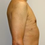 Gynecomastia Before & After Patient #1254