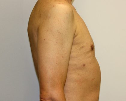 Gynecomastia Before & After Patient #1254