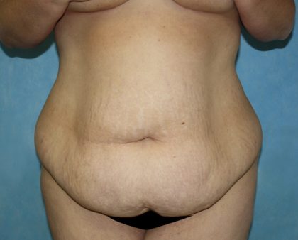 Tummy Tuck Before & After Patient #677