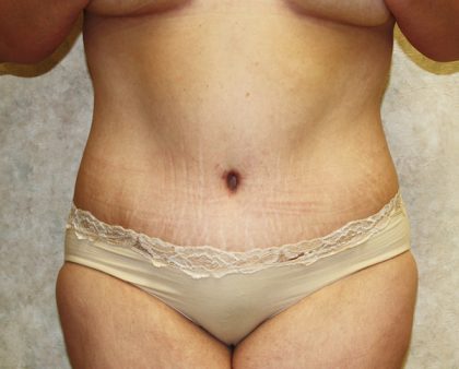 Tummy Tuck Before & After Patient #677